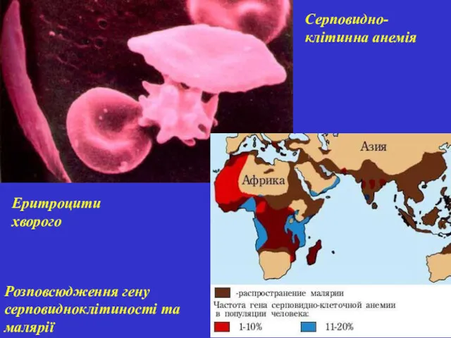 Серповидно-клітинна анемія Еритроцити хворого Розповсюдження гену серповидноклітиності та малярії