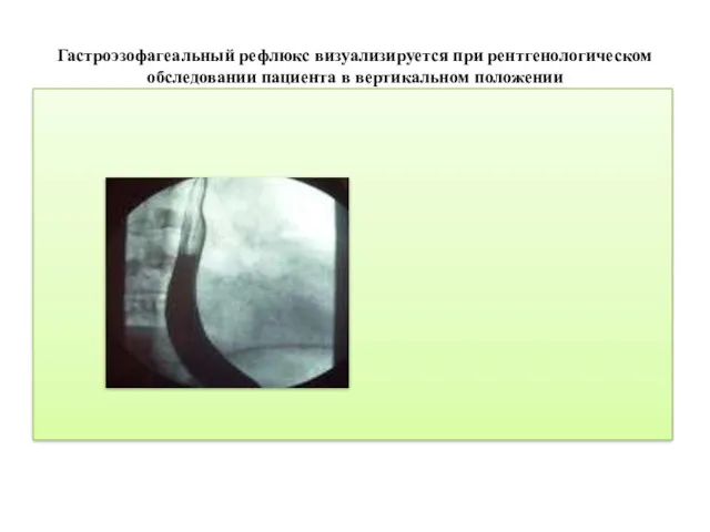 Гастроэзофагеальный рефлюкс визуализируется при рентгенологическом обследовании пациента в вертикальном положении