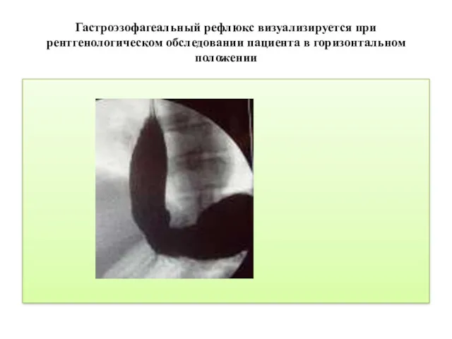 Гастроэзофагеальный рефлюкс визуализируется при рентгенологическом обследовании пациента в горизонтальном положении