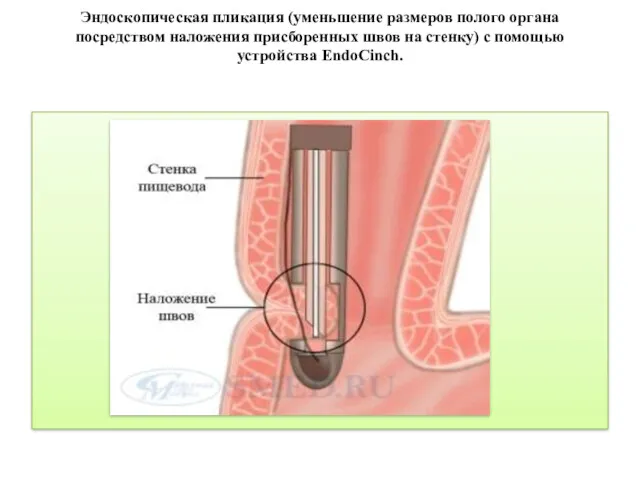 Эндоскопическая пликация (уменьшение размеров полого органа посредством наложения присборенных швов на стенку) с помощью устройства EndoCinch.