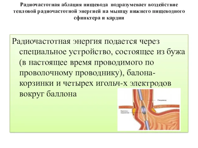 Радиочастотная аблация пищевода подразумевает воздействие тепловой радиочастотной энергией на мышцу