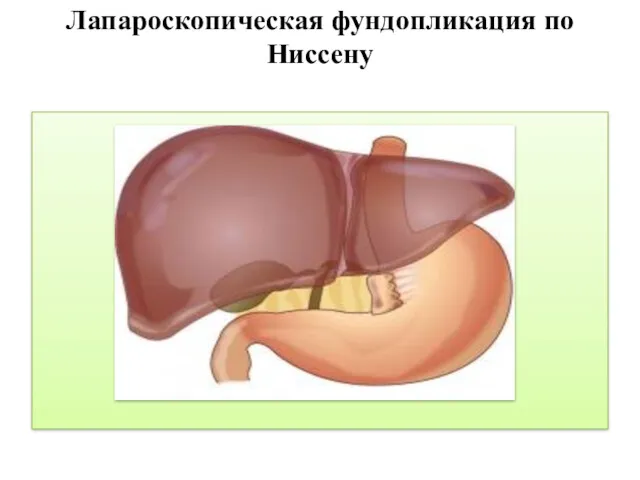 Лапароскопическая фундопликация по Ниссену