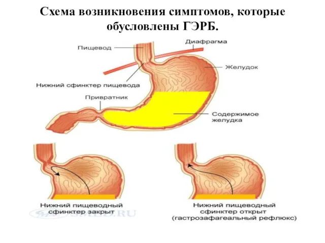 Схема возникновения симптомов, которые обусловлены ГЭРБ.