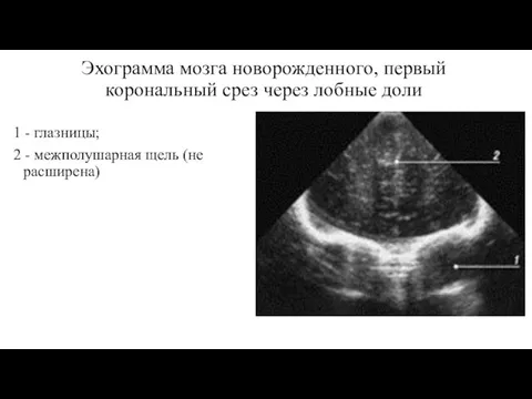 Эхограмма мозга новорожденного, первый корональный срез через лобные доли 1