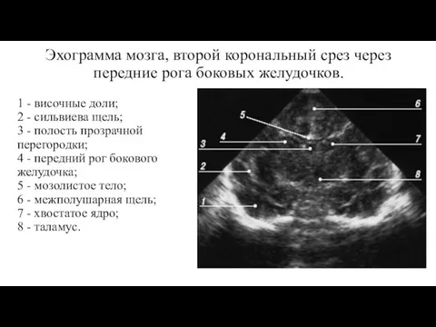 Эхограмма мозга, второй корональный срез через передние рога боковых желудочков.