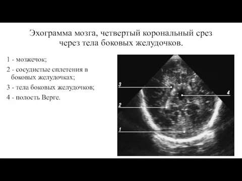 Эхограмма мозга, четвертый корональный срез через тела боковых желудочков. 1