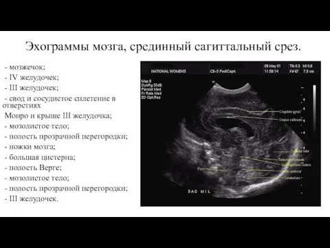 Эхограммы мозга, срединный сагиттальный срез. - мозжечок; - IV желудочек;