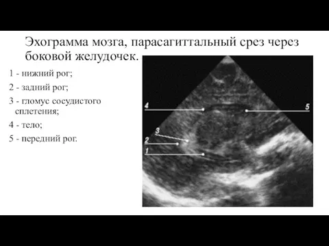 Эхограмма мозга, парасагиттальный срез через боковой желудочек. 1 - нижний