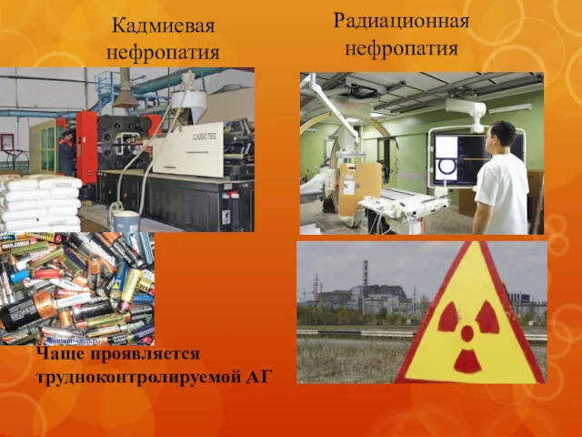 Кадмиевая нефропатия Радиационная нефропатия Чаще проявляется трудноконтролируемой АГ