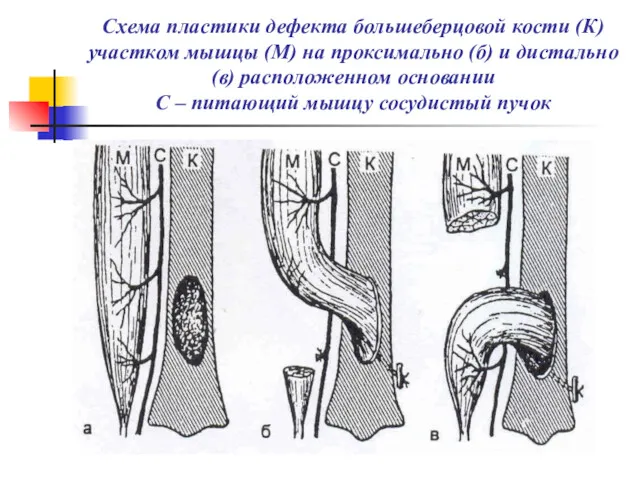 Схема пластики дефекта большеберцовой кости (К) участком мышцы (М) на проксимально (б) и