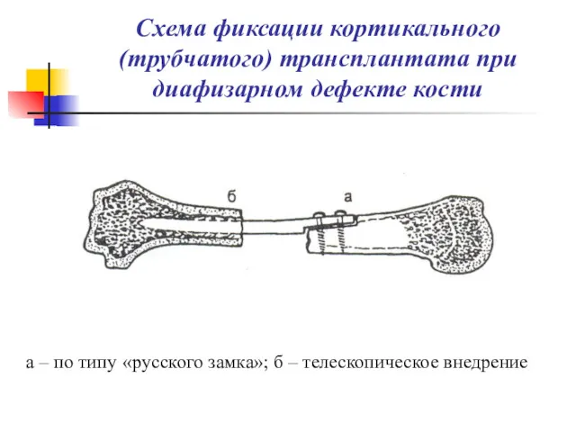 Схема фиксации кортикального (трубчатого) трансплантата при диафизарном дефекте кости а – по типу