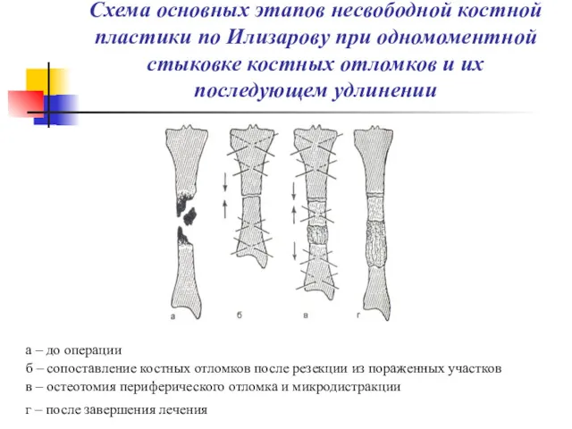 Схема основных этапов несвободной костной пластики по Илизарову при одномоментной стыковке костных отломков