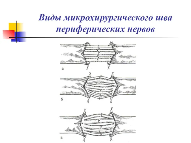 Виды микрохирургического шва периферических нервов