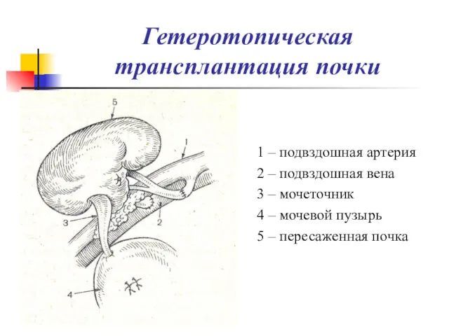 Гетеротопическая трансплантация почки 1 – подвздошная артерия 2 – подвздошная вена 3 –