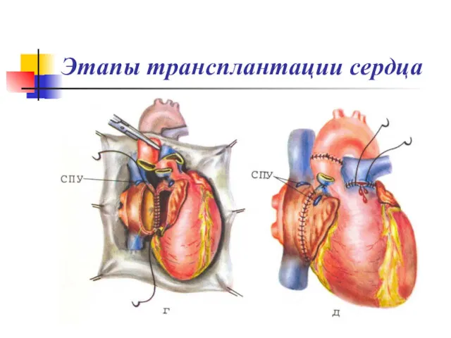 Этапы трансплантации сердца