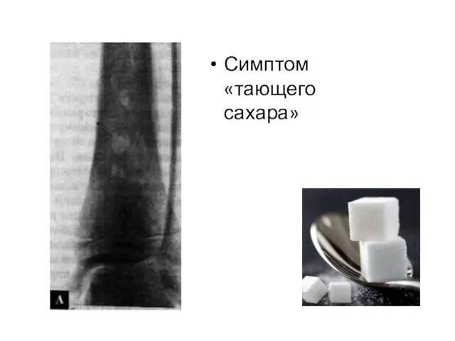 Симптом «тающего сахара»