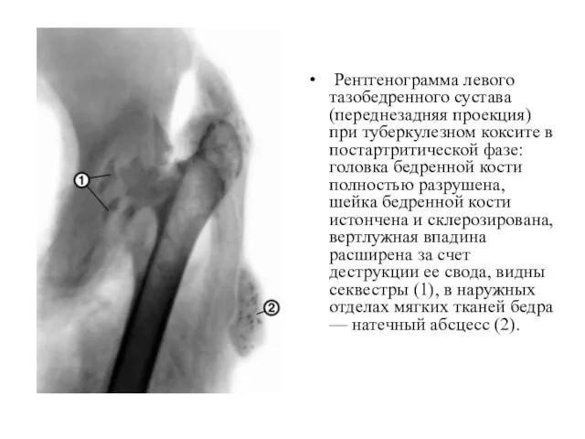 Рентгенограмма левого тазобедренного сустава (переднезадняя проекция) при туберкулезном коксите в