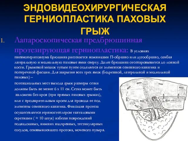 ЭНДОВИДЕОХИРУРГИЧЕСКАЯ ГЕРНИОПЛАСТИКА ПАХОВЫХ ГРЫЖ Лапароскопическая предбрюшинная протезирующая герниопластика: В условиях