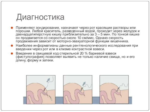 Диагностика Применяют зондирование, назначают через рот красящие растворы или порошки.