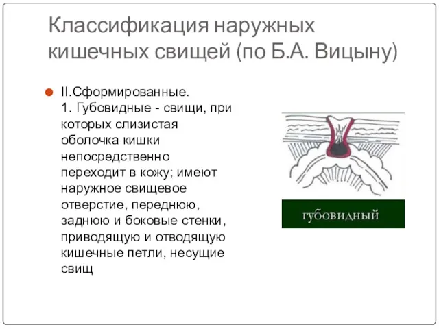 Классификация наружных кишечных свищей (по Б.А. Вицыну) II.Сформированные. 1. Губовидные