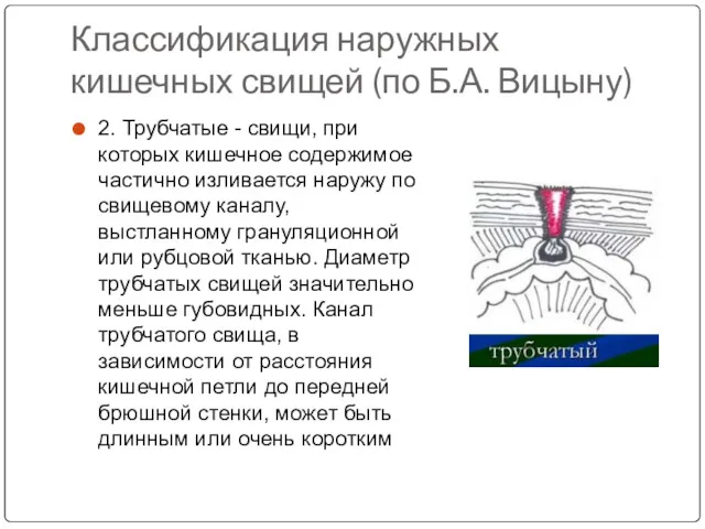 Классификация наружных кишечных свищей (по Б.А. Вицыну) 2. Трубчатые -