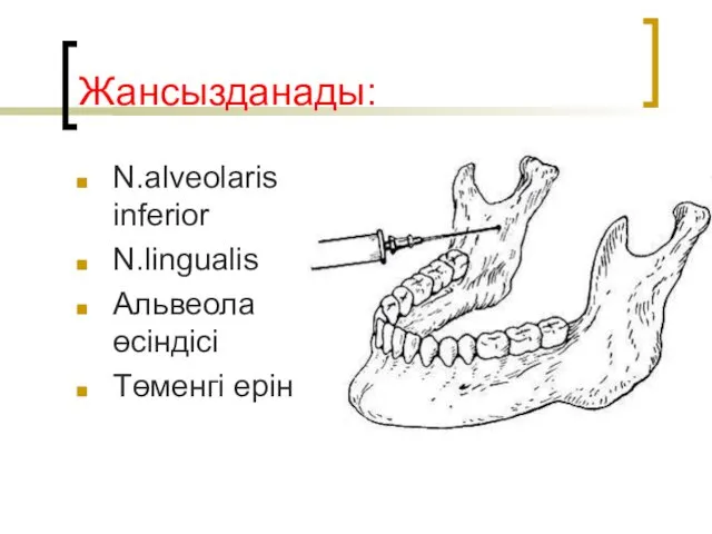 Жансызданады: N.alveolaris inferior N.lingualis Альвеола өсіндісі Төменгі ерін