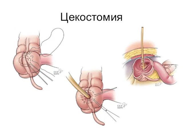 Цекостомия