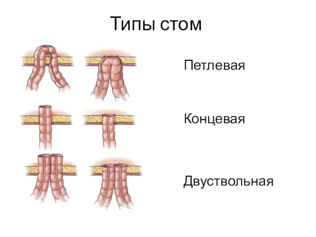 Типы стом Концевая Петлевая Двуствольная