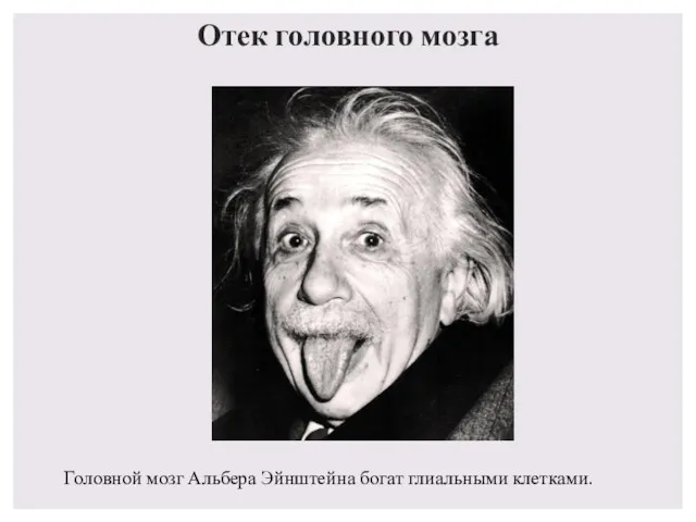 Отек головного мозга Головной мозг Альбера Эйнштейна богат глиальными клетками.