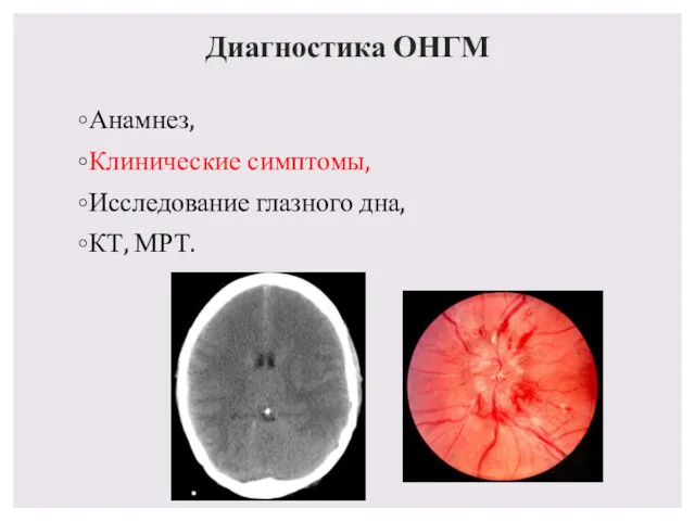 Диагностика ОНГМ Анамнез, Клинические симптомы, Исследование глазного дна, КТ, МРТ.