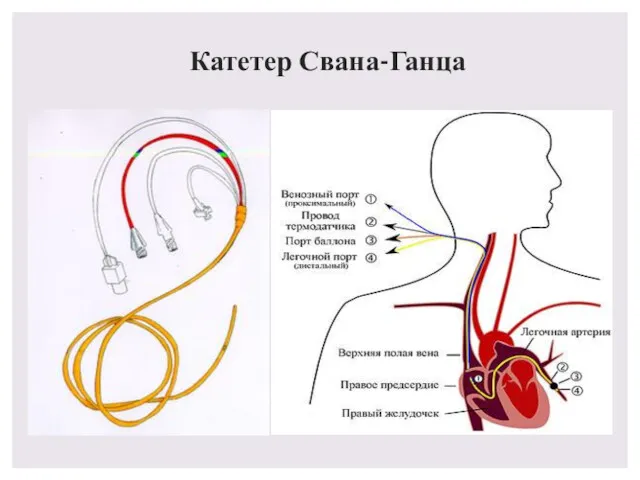 Катетер Свана-Ганца