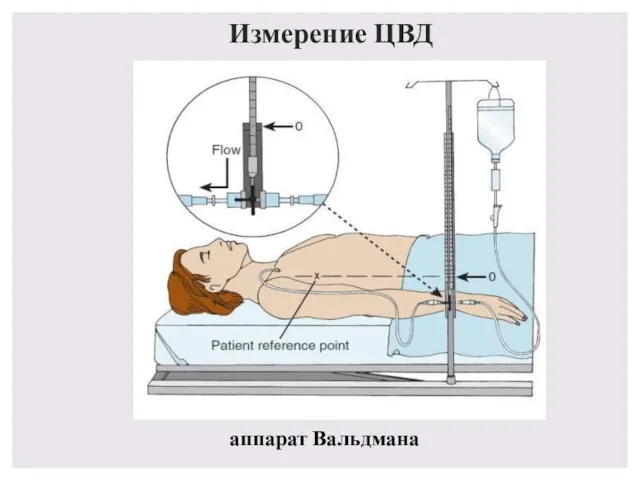 Измерение ЦВД аппарат Вальдмана