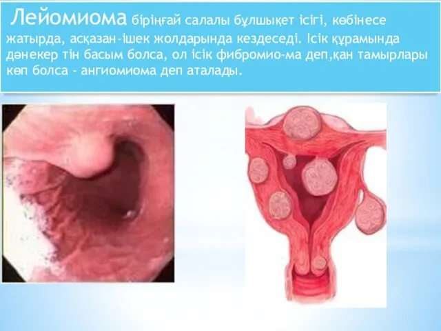 Лейомиома біріңғай салалы бұлшықет ісігі, көбінесе жатырда, асқазан-ішек жолдарында кездеседі. Ісік құрамында дәнекер