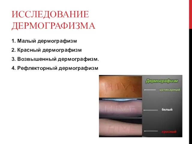 ИССЛЕДОВАНИЕ ДЕРМОГРАФИЗМА 1. Малый дермографизм 2. Красный дермографизм 3. Возвышенный дермографизм. 4. Рефлекторный дермографизм