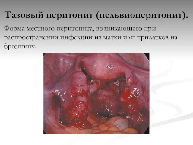 Тазовый перитонит (пельвиоперитонит). Форма местного перитонита, возникающего при распространении инфекции из матки или придатков на брюшину.