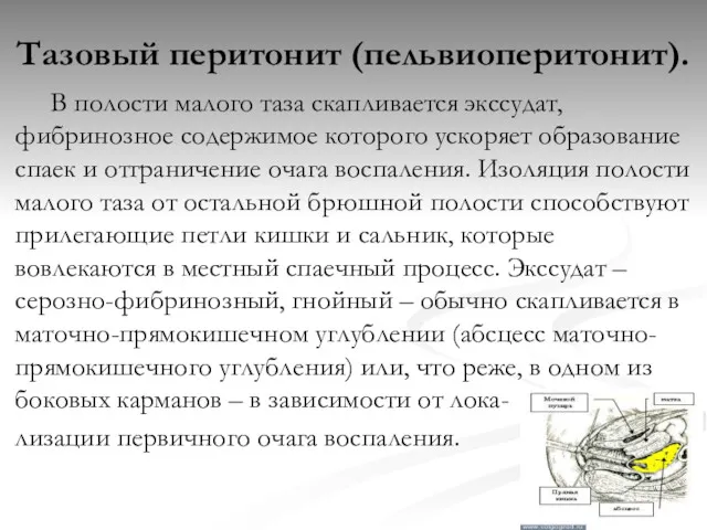 Тазовый перитонит (пельвиоперитонит). В полости малого таза скапливается экссудат, фибринозное