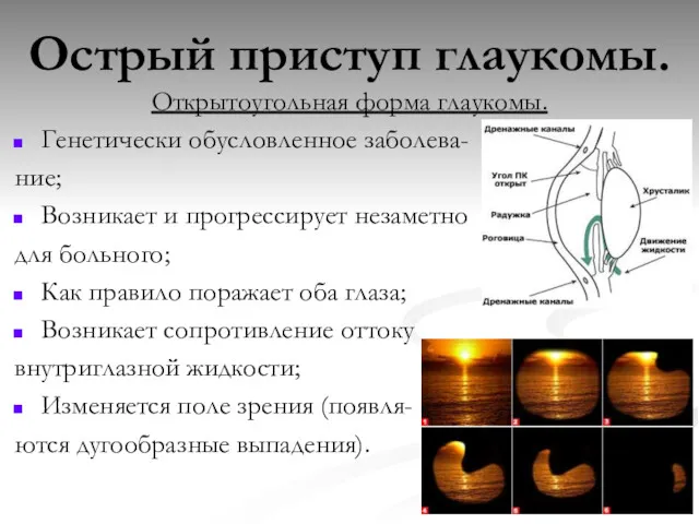 Острый приступ глаукомы. Открытоугольная форма глаукомы. Генетически обусловленное заболева- ние;