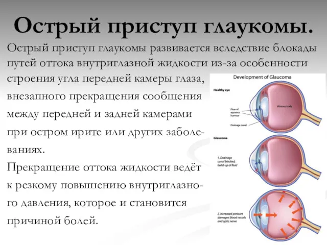 Острый приступ глаукомы. Острый приступ глаукомы развивается вследствие блокады путей