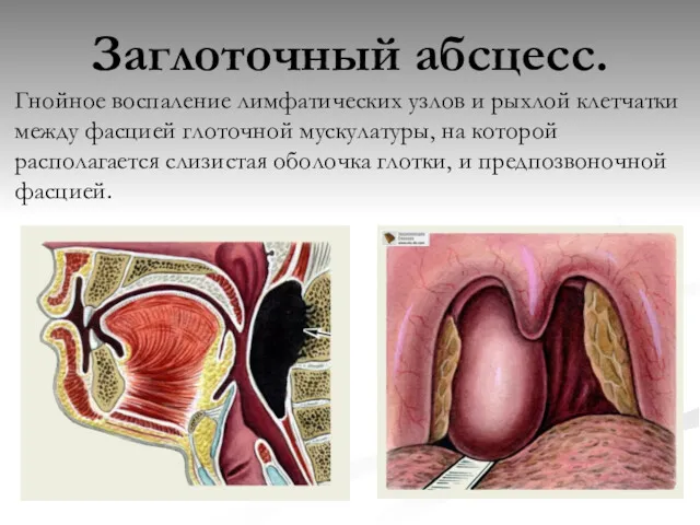 Заглоточный абсцесс. Гнойное воспаление лимфатических узлов и рыхлой клетчатки между