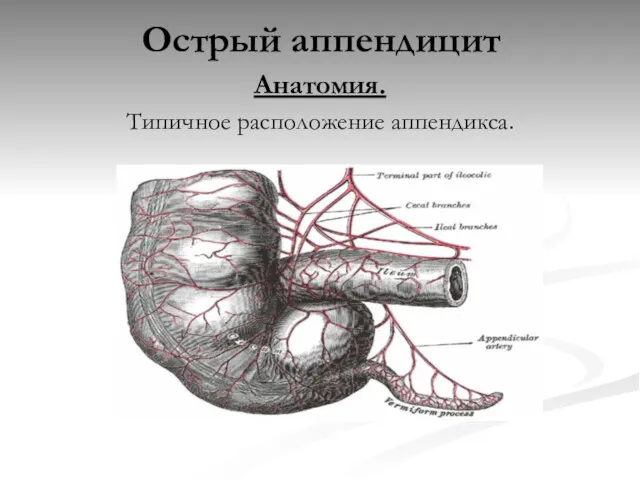 Острый аппендицит Анатомия. Типичное расположение аппендикса.