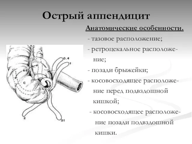 Острый аппендицит Анатомические особенности. - тазовое расположение; - ретроцекальное расположе-