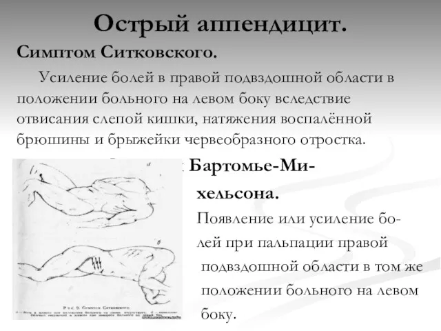 Острый аппендицит. Симптом Ситковского. Усиление болей в правой подвздошной области