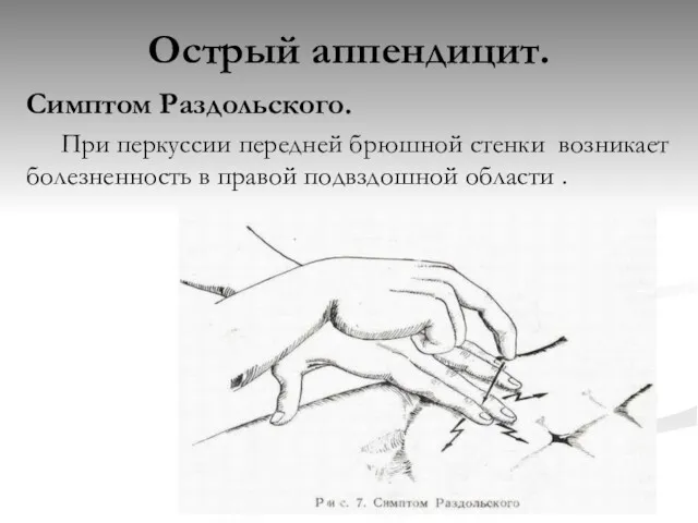 Острый аппендицит. Симптом Раздольского. При перкуссии передней брюшной стенки возникает болезненность в правой подвздошной области .