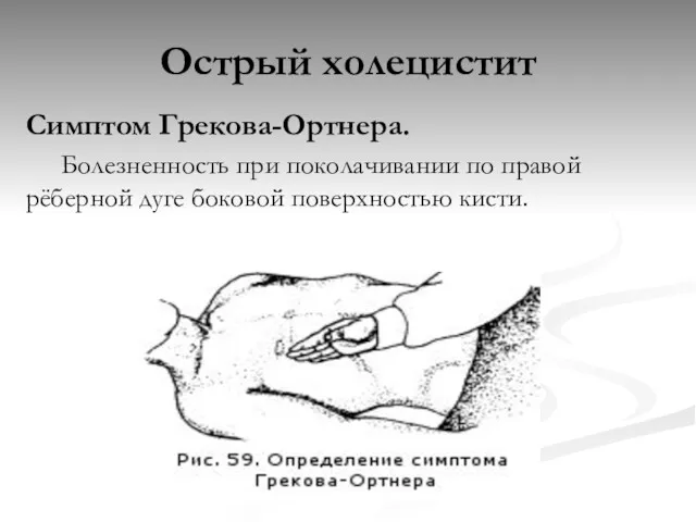 Острый холецистит Симптом Грекова-Ортнера. Болезненность при поколачивании по правой рёберной дуге боковой поверхностью кисти.