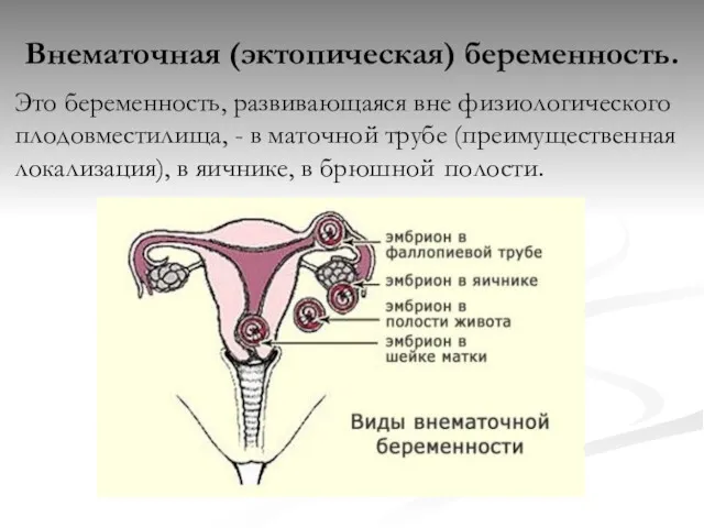 Внематочная (эктопическая) беременность. Это беременность, развивающаяся вне физиологического плодовместилища, -