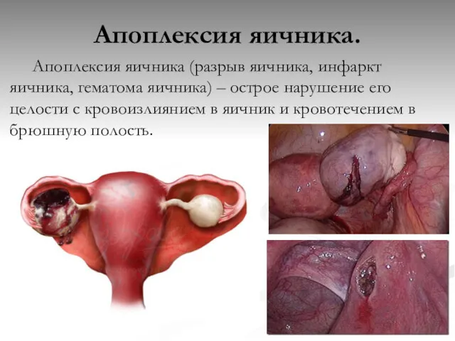 Апоплексия яичника. Апоплексия яичника (разрыв яичника, инфаркт яичника, гематома яичника)