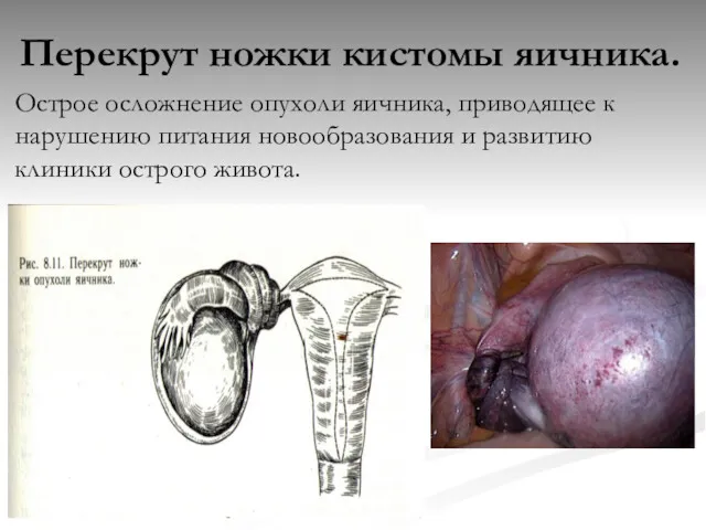 Перекрут ножки кистомы яичника. Острое осложнение опухоли яичника, приводящее к