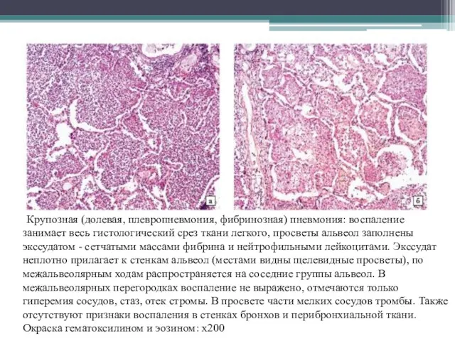 Крупозная (долевая, плевропневмония, фибринозная) пневмония: воспаление занимает весь гистологический срез