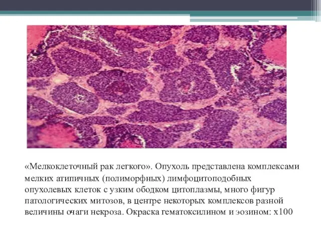 «Мелкоклеточный рак легкого». Опухоль представлена комплексами мелких атипичных (полиморфных) лимфоцитоподобных