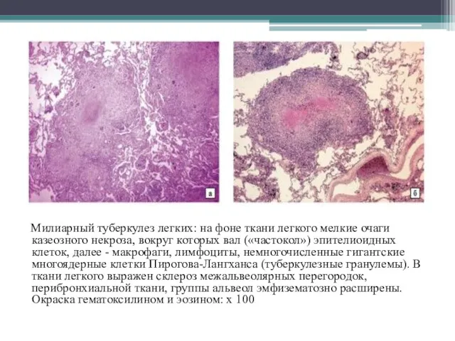 Милиарный туберкулез легких: на фоне ткани легкого мелкие очаги казеозного некроза, вокруг которых